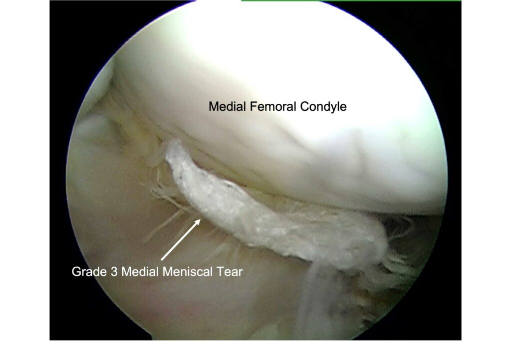 meniscal tear, type 3